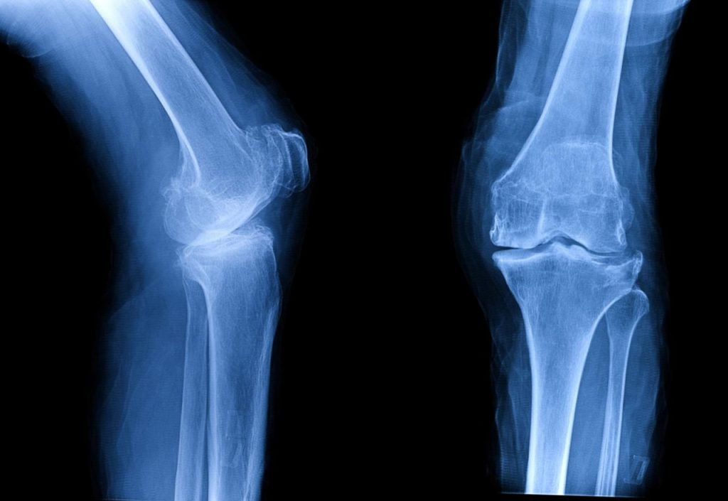knee replacement surgery in madurai