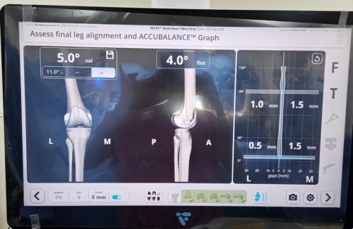 The perfect alignment