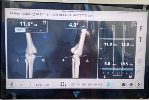 A really bad valgus knee